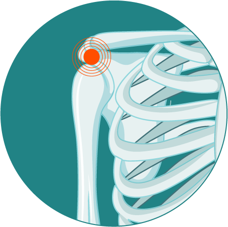 Lesiones de hombro - Ulrike Göpel - Traumatologia en Tenerife Norte y Sur