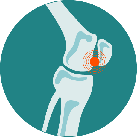 Lesiones de rodilla - Ulrike Göpel - Traumatologia en Tenerife Norte y Sur
